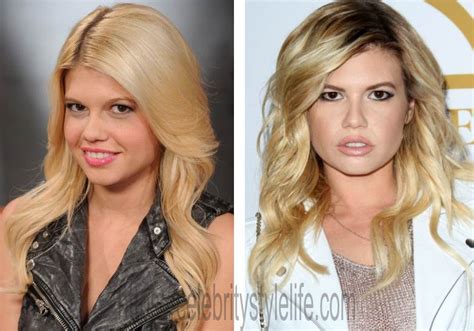 chanel west coast plastic surgery